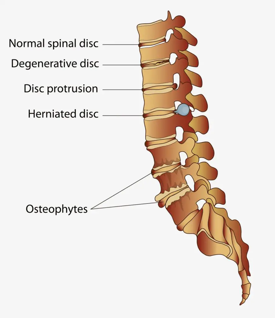 Spinal diseases of the spine diagram showing disc protrusion, herniated disc, degenerative disc, and osteophytes.