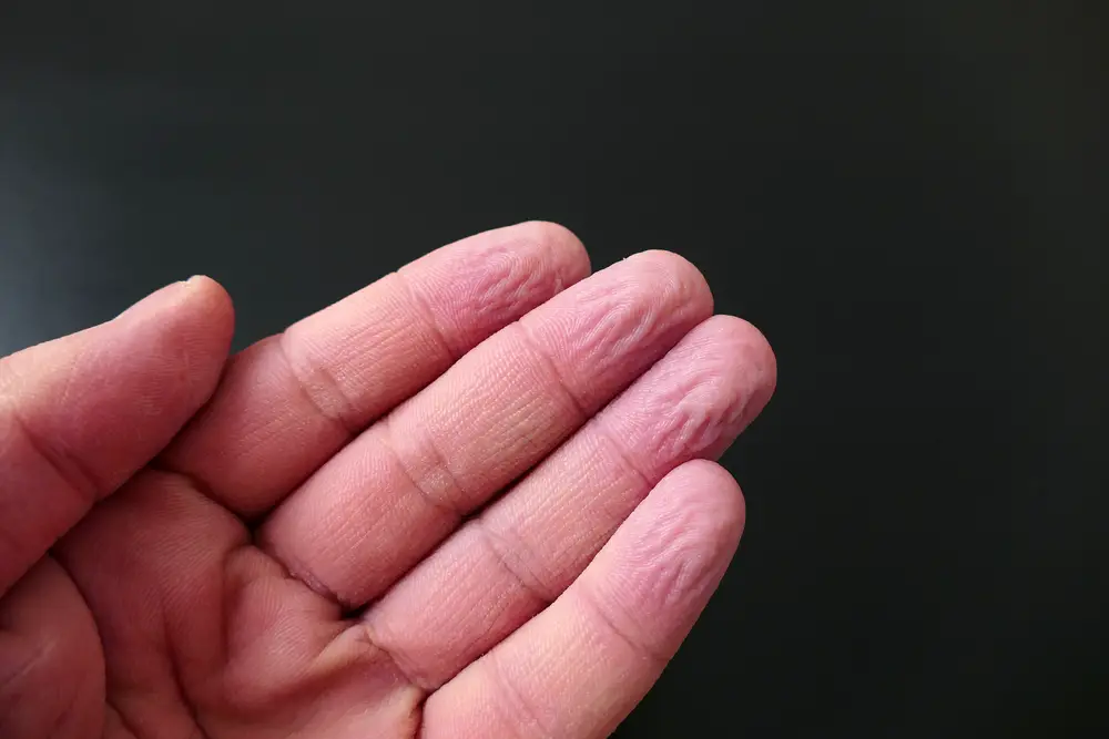 Fingers that are wrinkle or prune up after being in water.